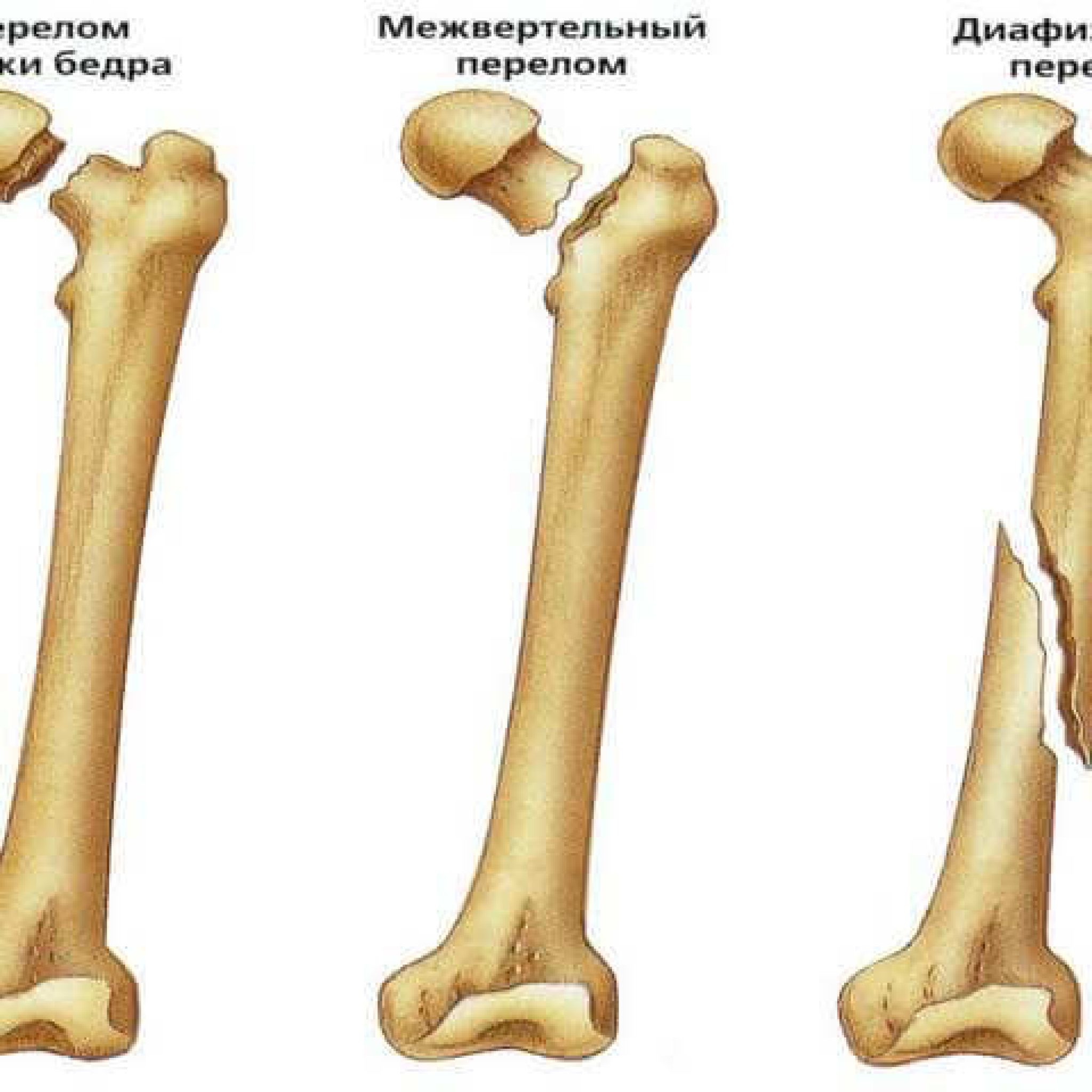 Оскольчатый перелом бедренной кости